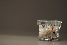 嘉義市植牙費用牙醫助您了解植牙方式正確選擇植牙的費用