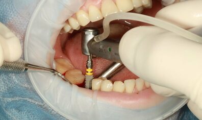 牙齒-假牙解決缺牙